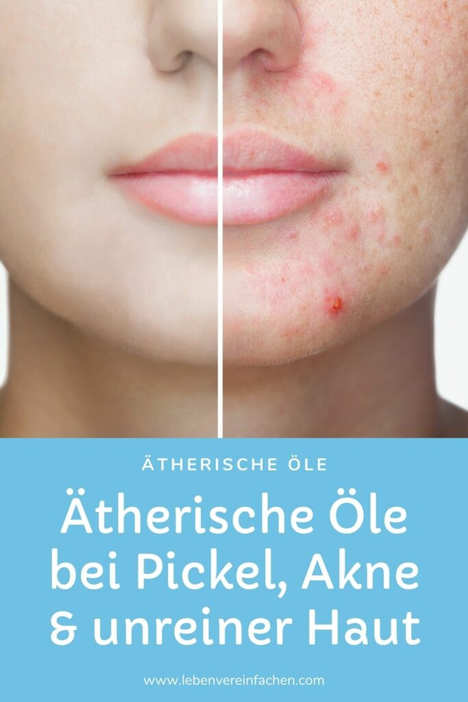 Ätherische Öle gegen unreine Haut und Akne